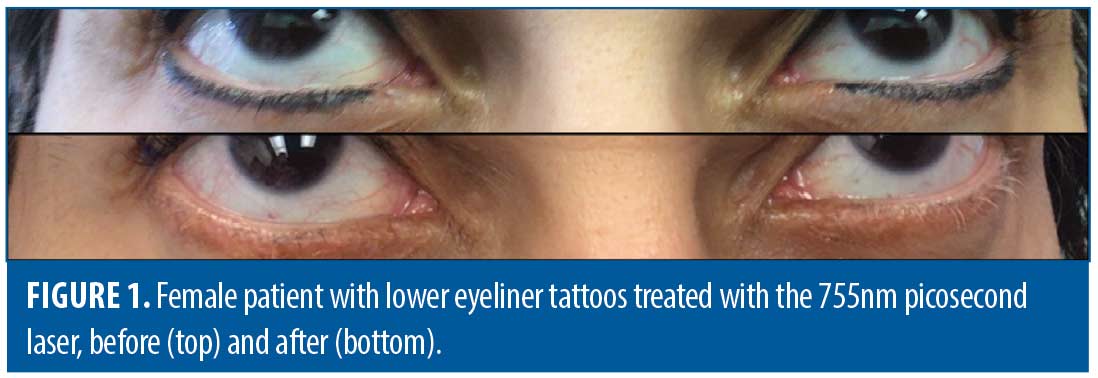 SPMU Eyeliner tattoo removal with Ocular shields