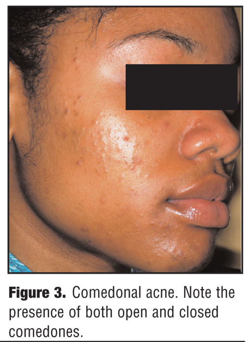 A Review of Acne in Ethnic Skin Pathogenesis Clinical